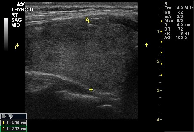 Thyroid Ultrasound 8231